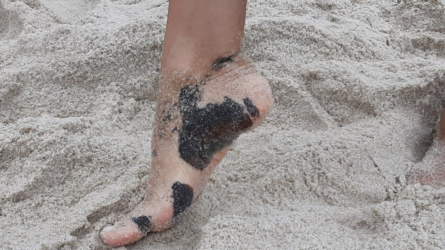 Resultado de imagem para Voluntários relatam intoxicação após manuseio de óleo em praias