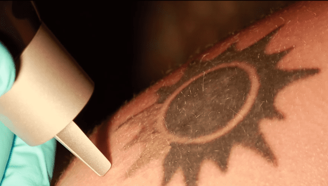 De remoção à cobertura, tatuagens podem ser revertidas
