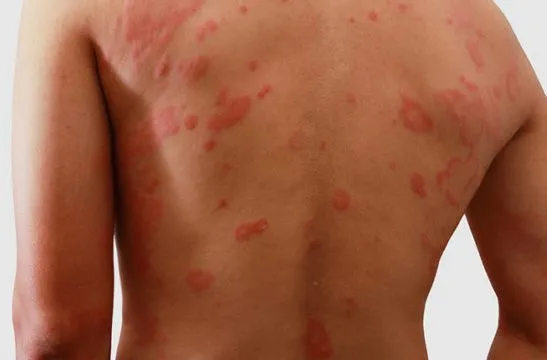 Dermatite atopica