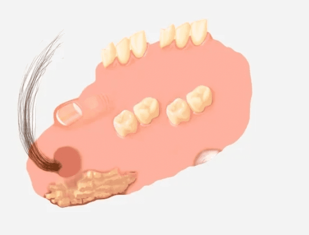 Toratoscomia Teratoma: tumor que tem aspecto bizarro atinge mulheres em idade fértil ...