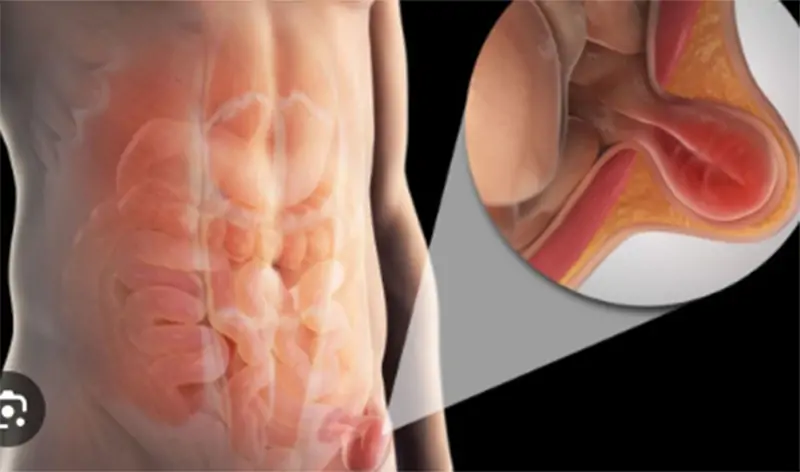 Entenda o que é câncer inguinal, que causou a morte de Anderson, do Molejo