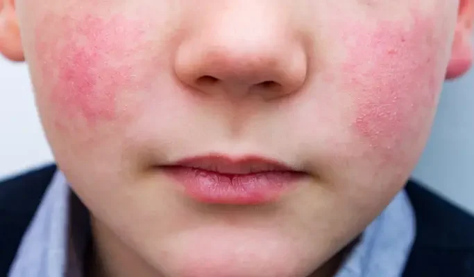 Saiba o que é o eritema infeccioso, conhecido como síndrome da bochecha ...
