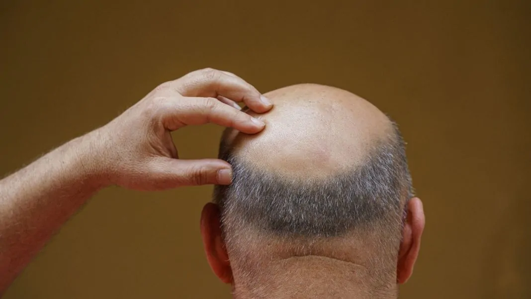 queda de cabelo- imagem ilustrativa